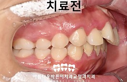 수술전