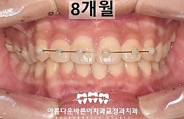 수술후