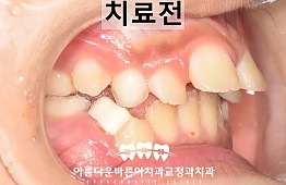 수술전