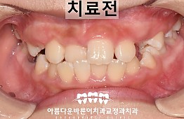 수술전