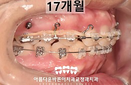 수술후