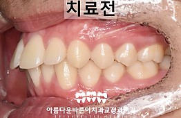 수술전