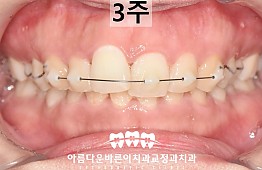 수술후