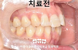 수술전