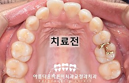 수술전