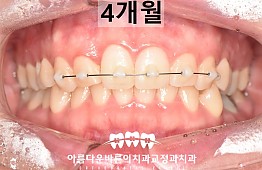 수술후