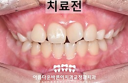 수술전