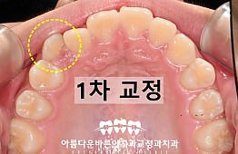 수술후