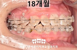 수술후