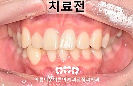 수술전