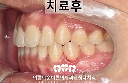 수술후