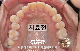 수술전