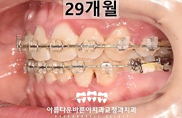 수술후