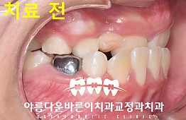 수술전