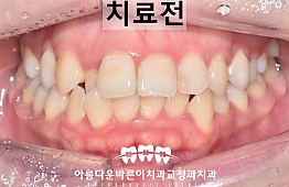 수술전