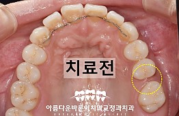 수술전