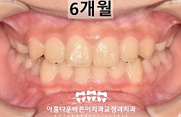 수술후