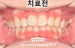 수술전