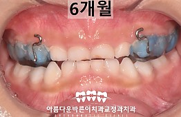 수술후