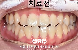 수술전