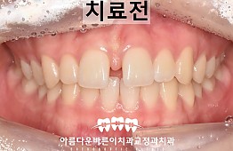 수술전