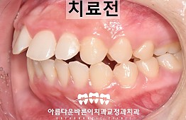 수술전