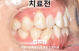 수술전