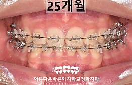 수술후