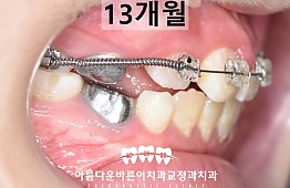 수술후