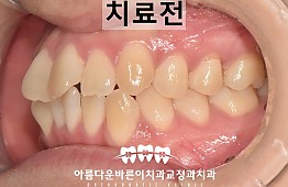 수술전