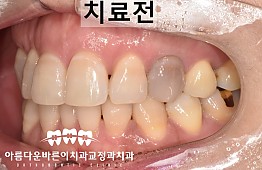 수술전