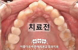 수술전