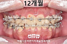 수술후