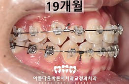 수술후