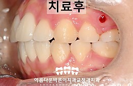 수술후