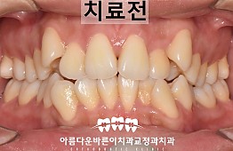 수술전