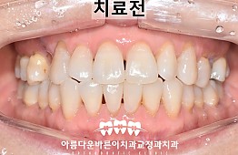 수술전