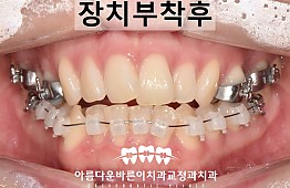 수술후