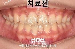 수술전