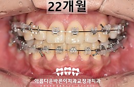 수술후