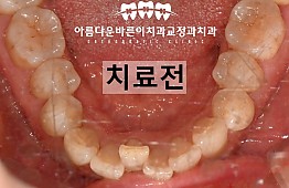 수술전