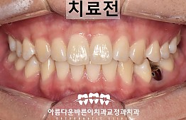 수술전