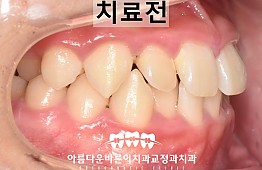 수술전