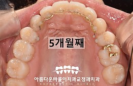 수술후