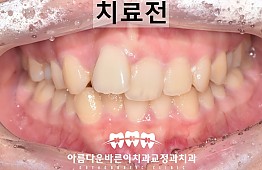 수술전