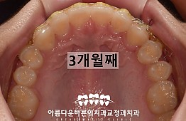 수술후