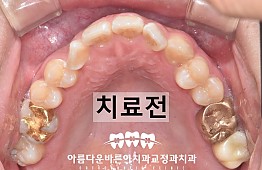 수술전