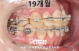 수술후