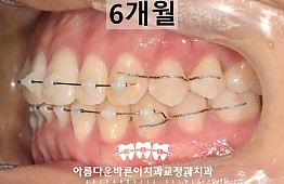 수술후