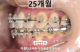 수술후